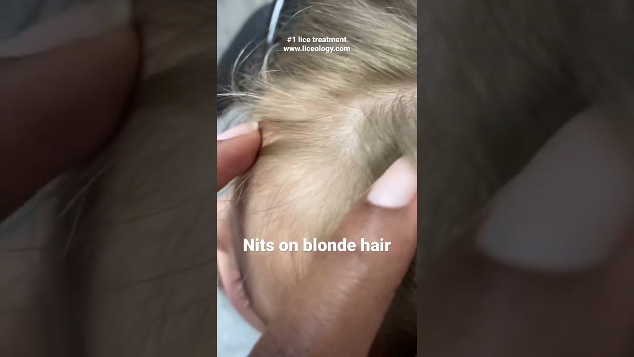 Lice In Blonde Hair How It Looks Like and What To Do With It  LiceDoctors