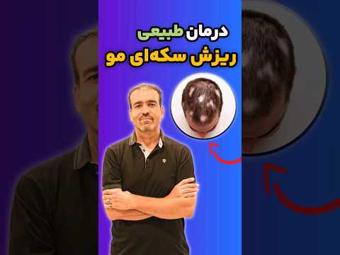 #shorts درمان طبیعی برای ریزش سکه‌ای مو