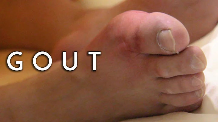 Relief from Gout Pain - Principal Podiatrist Michael Lai, East Coast Podiatry - DayDayNews