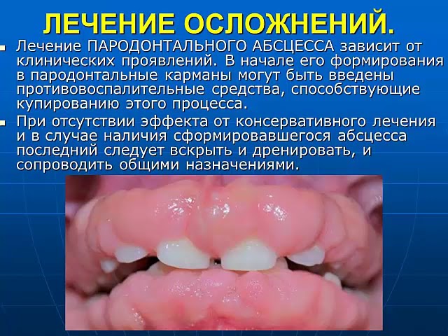 Местное лечение заболеваний пародонта