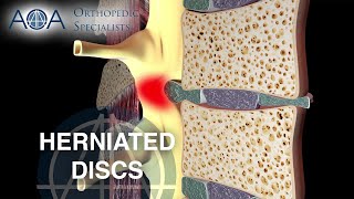 AOA Orthopedic Specialists - Herniated Discs