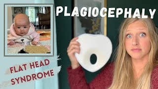 Plagiocephaly | Flat Head Syndrome | My baby has a Flat Head