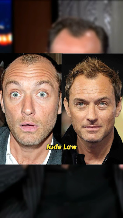 CELEBRITIES BEFORE VS AFTER HAIR TRANSPLANTATION #shorts