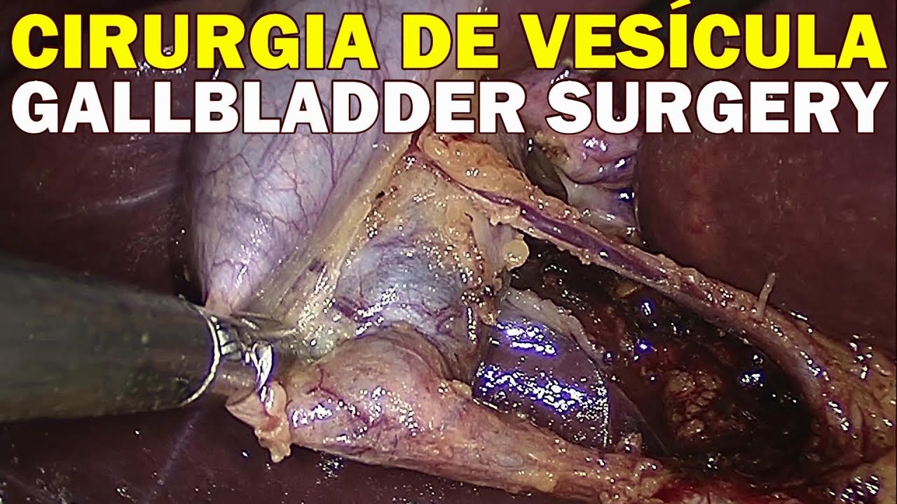 Cirurgia De Fimose Quanto Tempo Dura Cirurgia de Vesícula por Vídeo - Completa - FullHD 60fps + 2 GoPro 04