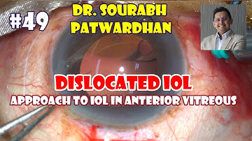 Commented 49 approach to Dislocated IOL in anterior Vitreous Dr Sourabh Patwardhan