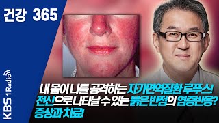 [건강365]내 몸이 나를 공격하는 자가면역질환 루푸스! 전신으로 나타날 수 있는 붉은 반점의 염증반응? 증상과 치료! #루푸스#희귀난치성질환 #건강365 #자가면역질환