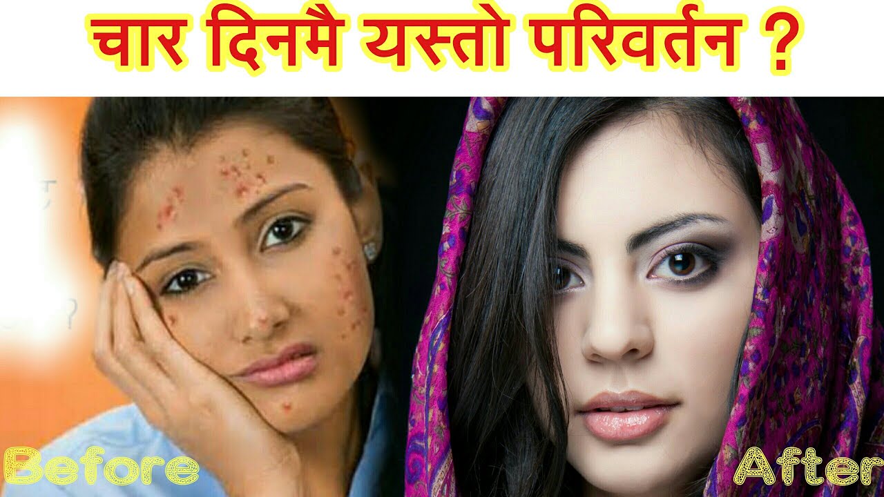 अनुहार चम्किलो बनाउने अचुक उपाए ! चार दिन गरेर हेर्नूस Face Treatment