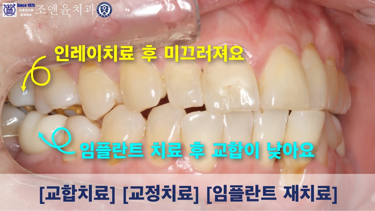[내일남] 임플란트 치료 후 교합이 낮아요 / 인레이 치료 후 교합이 미끄러져요 : 여러 교합문제를 해결하기 위해서는 교정치료뿐만 아니라 임플란트치료와 보철치료가 동시에 필요합니다