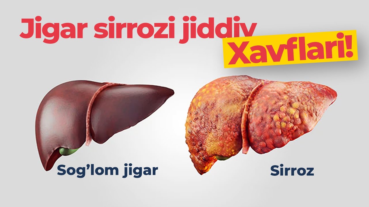 Jigar sirrozi xavflari!!!