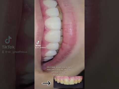 ציפויי חרסינה למינייט סוף סוף אפשר לחייך ד ר גלעד פיסקוס 