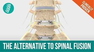 How the Prodisc L Lumbar Artificial Disc Moves | Motion-Preserving Alternative to Fusion