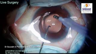 Soft cataract incomplete divisions Live surgery from Nandadeep Eye Hospital Dr Sourabh Patwardhan screenshot 2