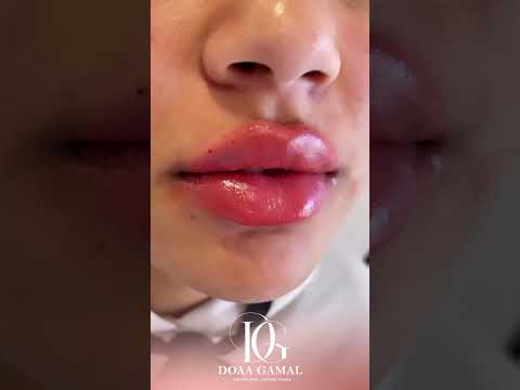 قبل وبعد حقن الفيلر مع دكتوره دعاء جمال أفضل نتائج حقن فيلر شفايف    