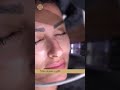 The Non Surgical Skin Tightening Solution Morpheus8 | The Powerful Benefits of Microneedling