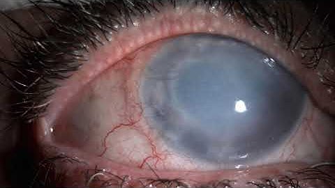 Mitomycin C Intravascular Chemoembolization - MICE Technique