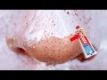 FIRST TIME USING Colgate to Remove Blackheads &  Whiteheads From Your Nose | REMOVES EVERYTHING