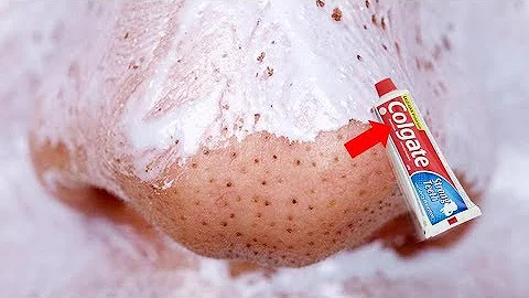 Does toothpaste actually remove blackheads?