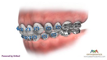 Life with Braces - Brushing, Flossing & Mouthguard