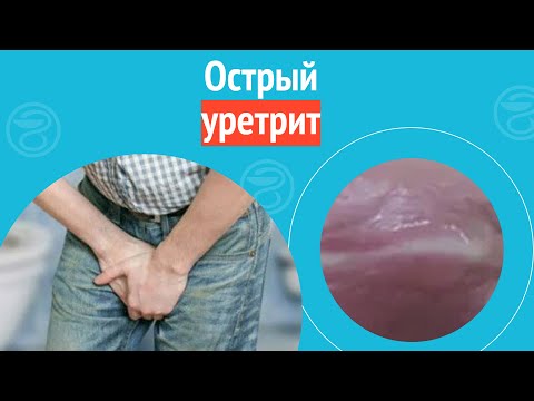 💣 Острый гонорейно-трихомонадно-хламидийно-уреаплазменный уретрит. Клинический случай №1100