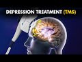 How Transcranial Magnetic Stimulation (TMS) Is Performed To Treat Depression?