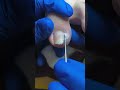 Impacted or Ingrown Toenail Pedicure #shorts #short