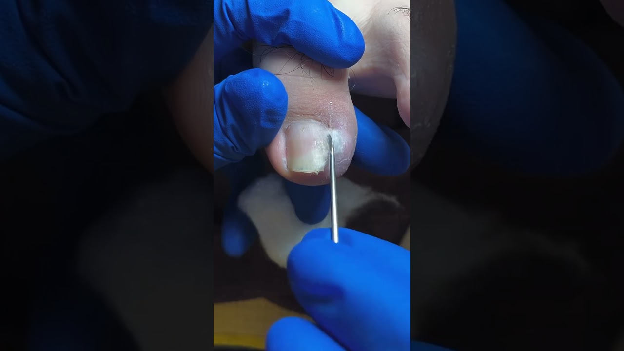 Impacted or Ingrown Toenail Pedicure #shorts #short