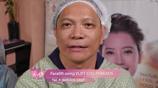 Facelift using VLIFT COG THREADS