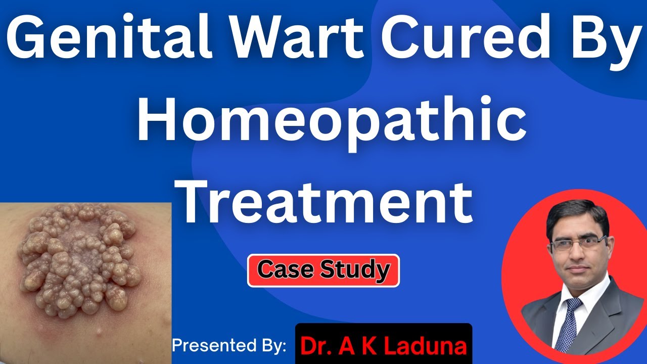 Genital wart Cured by Homeopathic Treatment: Case Study