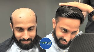Before & After | Hair System | Non-Surgical Hair Replacement System Men/Women | UK/USA/International