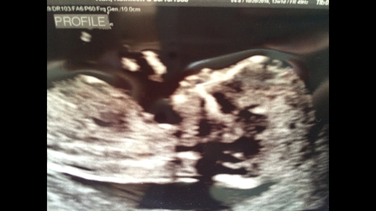 14 WEEKS PREGNANT W T1 DIABETES NUCHAL TRANSLUCENCY SCAN YouTube