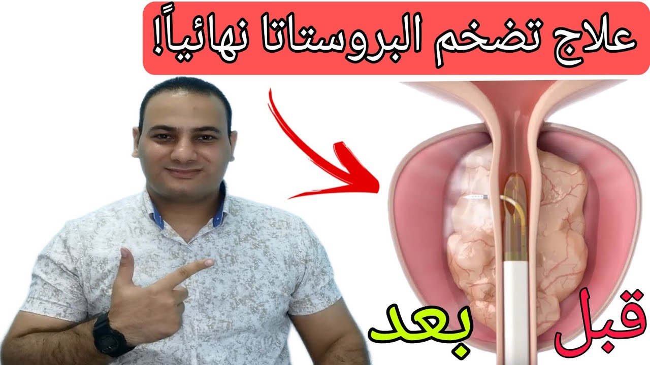 علاج تضخم البروستاتا نهائياً بأحدث تقنية 