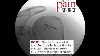 Glenohumeral (Shoulder) Injection under Fluoroscopic Guidance - ThePainSource.com