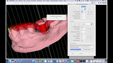 Undercuts Removal with Dental3DPlugin 2.6.2