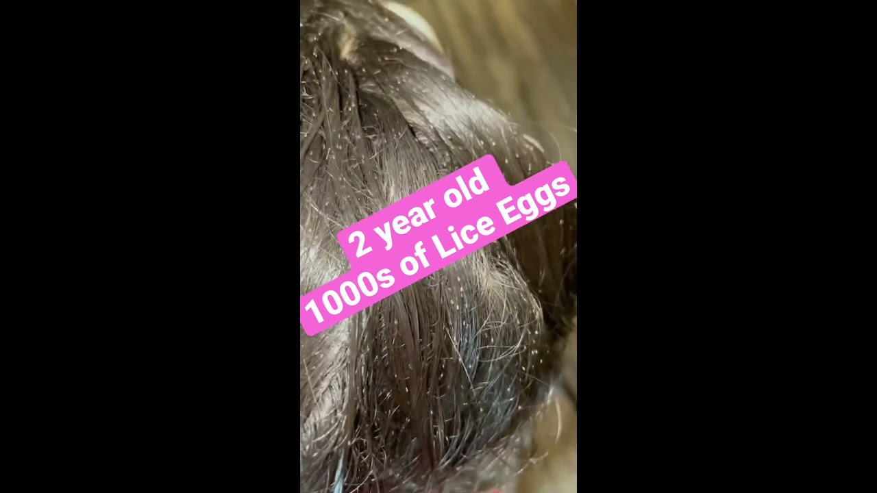 Toddler With 1000s Of Lice Eggs L Extreme Infestation Removal Service