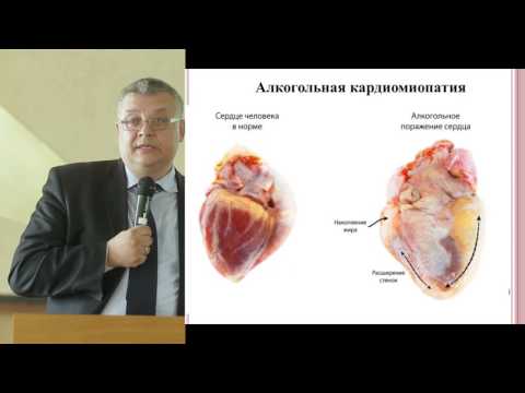Саливончик Д.П., Алкогольная кардиомиопатия