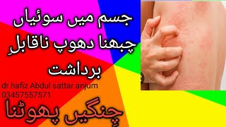 jism me soiyan chubhna|prickl|cholinergic urticaria|Dr hafiz|dr hafiz Abdul sattar anjum/Urdu/Hindi