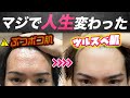 【激変】半年間、何をしても治らなかった肌荒れを改善させた方法！今夜から自宅で簡単にできちゃいます✨