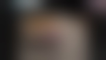 Proximal humerus fractures Part 1