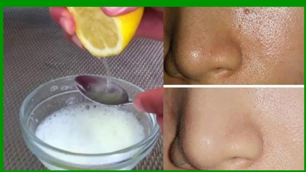 Mira Cómo quitar La grasa excesiva del rostro se quita en tan solo 5