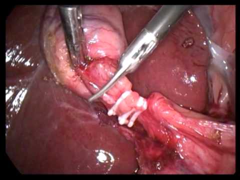 Lap Cholecystectomy Unedited 318 Thick Walled Chronic Cholecystitis With Mils Omental Adhesion