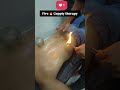 Cuppiy tretment | Cupping therapy | fire 🔥 Cuppiy | hizama 😱 shocked #cupping #shortsfeed