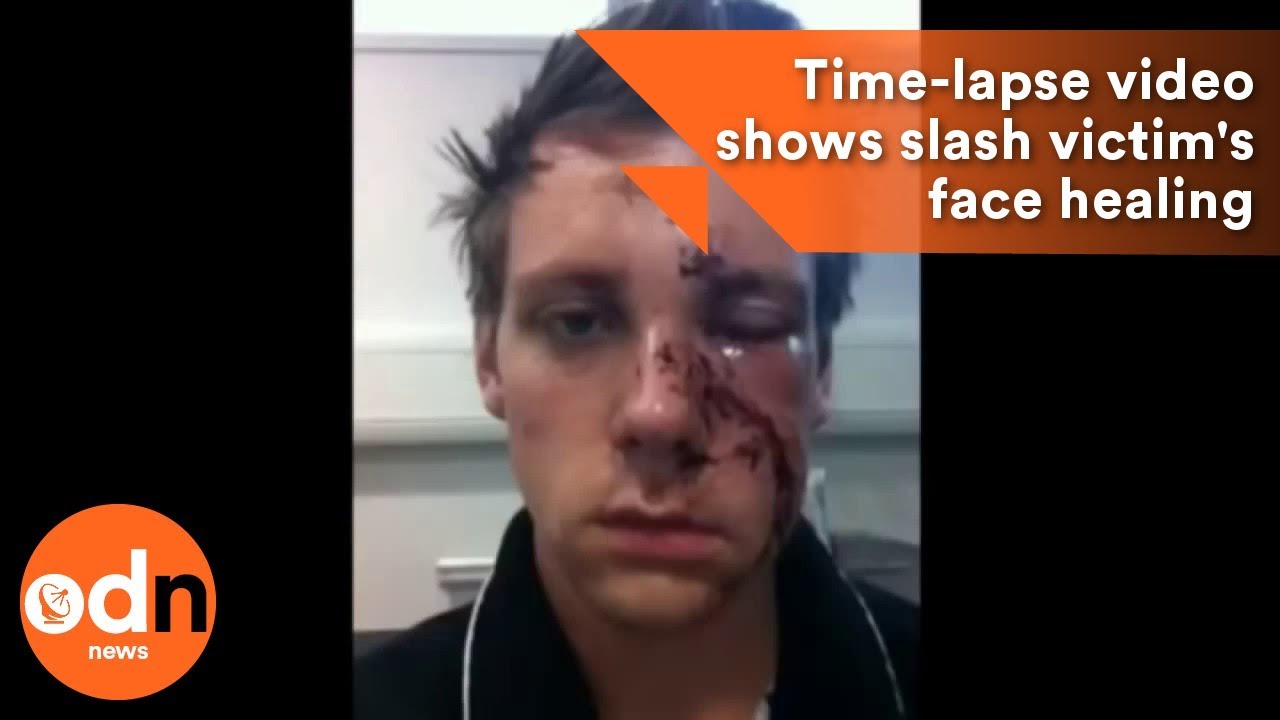 Time lapse video of guttate pikkelysömör gyógyulás