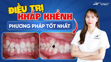 Top Các Phương Pháp Điều Trị Răng Khấp Khểnh I Phương Pháp Nào Hiệu Quả Nhất