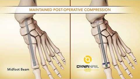 DynaNail Mini® Medial Column - Animation