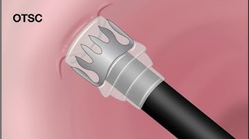 HCC 1472-Lesson-11a2 -Hemostatic Devices-Over the Scope Clips