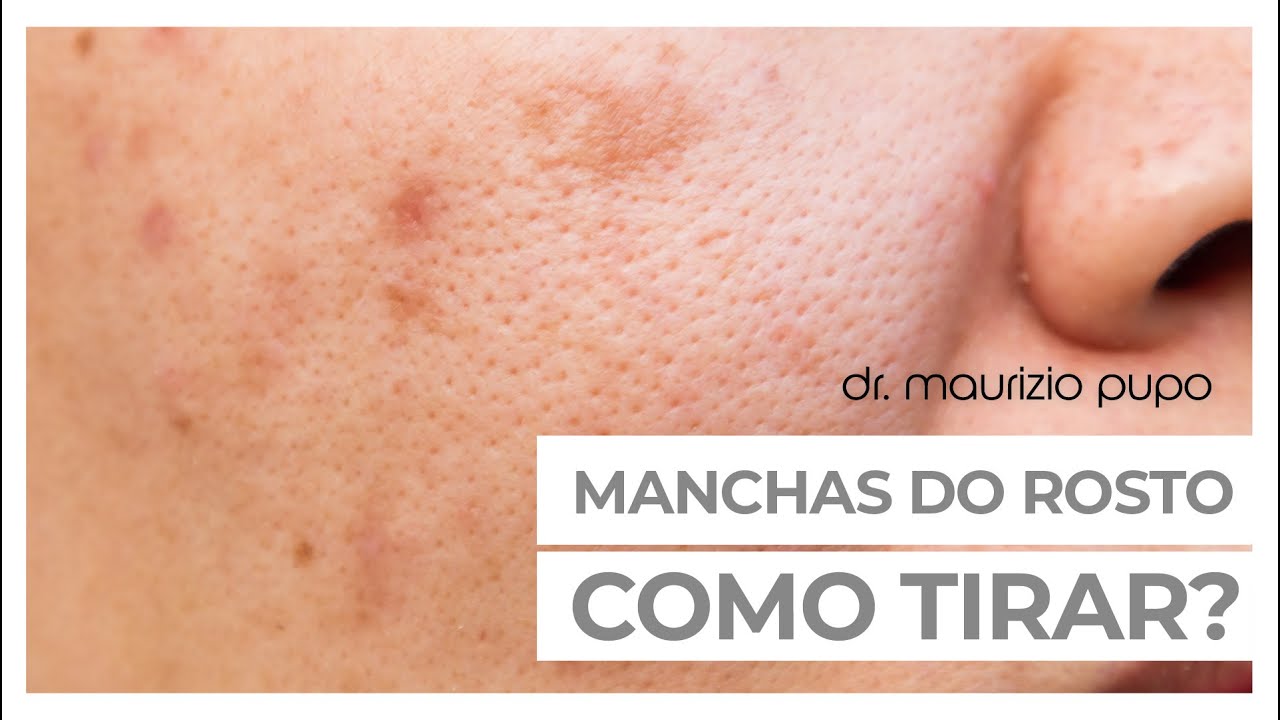 MANCHAS NO ROSTO. COMO TIRAR? - Dr. Maurizio Pupo