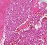 Histopathology Ovary--Granulosa cell tumor