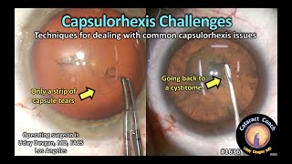 CataractCoach 1636: capsulorhexis challenges... even for expert surgeons