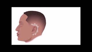 Cochlear implant procedure