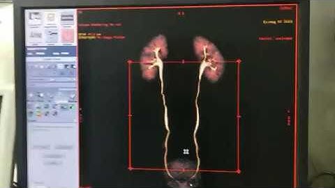 Full Work Of CT Urography (Urogram with 3D) On GE 16 Slice Scanner.
